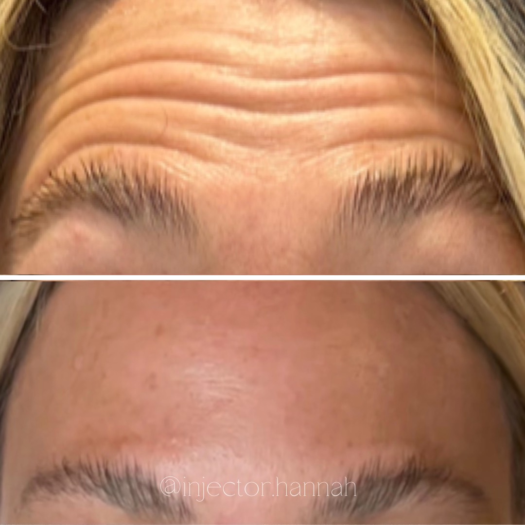 Forehead lines before/after – smoother after 2 weeks